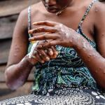 Mpox Outbreak in Africa Sees 34.5% Decline as WHO and Africa CDC Drive Vaccination & Response Efforts
