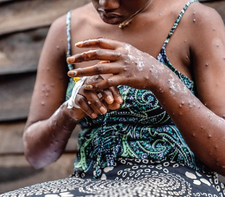 Mpox Outbreak in Africa Sees 34.5% Decline as WHO and Africa CDC Drive Vaccination & Response Efforts