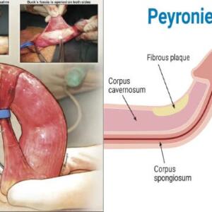 Peyronie’s Disease Treatments and Medications: Causes, Symptoms & Diagnosis in Ghana
