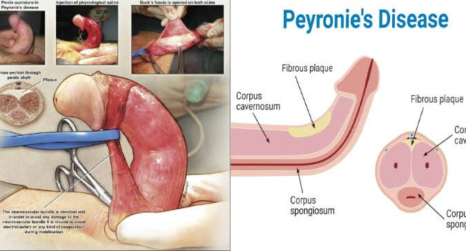 Peyronie’s Disease: Causes, Symptoms, Diagnosis, Effects & Treatment Options