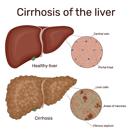 Hepatitis B: Causes, Symptoms, Transmission, Prevention & Treatment Medication for a Healthy Life