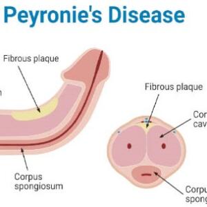 Peyronie’s Disease Treatments and Medications: Causes, Symptoms & Diagnosis in Ghana