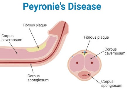 Peyronie’s Disease: Causes, Symptoms, Diagnosis, Effects & Treatment Options