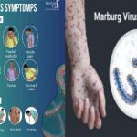 Marburg virus disease (MVD): Symptoms, Causes, Transmission, Prevention and Treatment Medication
