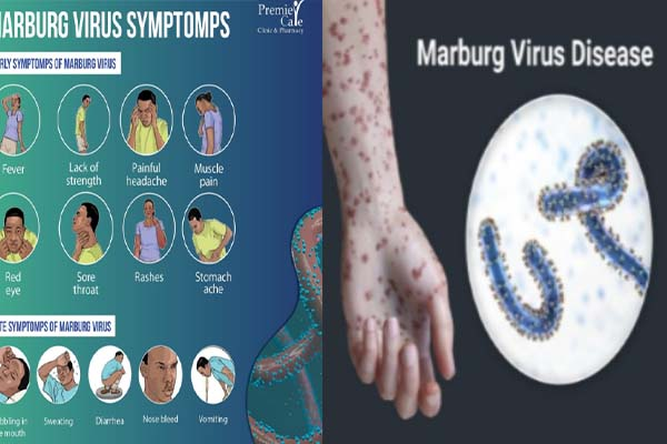 Marburg virus disease (MVD): Symptoms, Causes, Transmission, Prevention and Treatment Medication