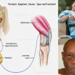 Paralysis: Symptoms, Causes, Types, Diagnosis, Prevention & Treatment