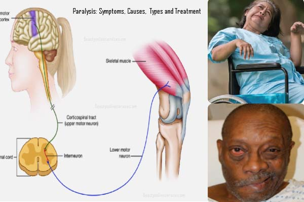 Paralysis treatment in Ghana