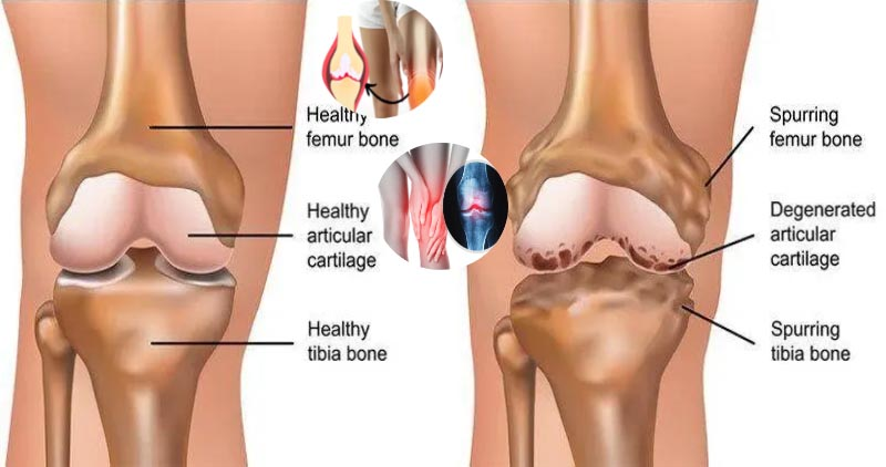 Osteoarthritis: Symptoms, Causes, Diagnosis & Treatment Medication