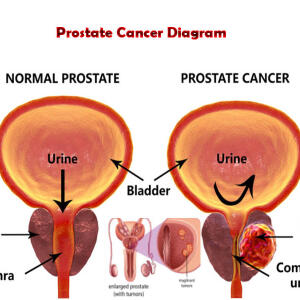 Prostate Cancer Treatment Medicine in Ghana