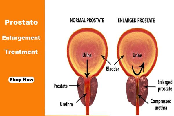 Prostate Enlargement