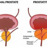 Prostatitis: Causes, Symptoms, Diagnosis & Treatment Medicine