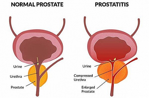 Prostatitis: Causes, Symptoms, Diagnosis & Treatment Medicine