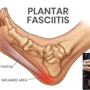 Plantar Fasciitis: Symptoms, Causes, Diagnosis, Physiotherapy, Exercises, Stretches & Treatment