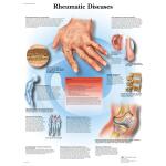 Rheumatic Diseases: Symptoms, Types, Medication, and Rheumatologist Guide