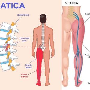 Joint, Sciatica and Nerve Pain Treatment Supplements & Herbal Medicines to Relieve Pain, Ghana