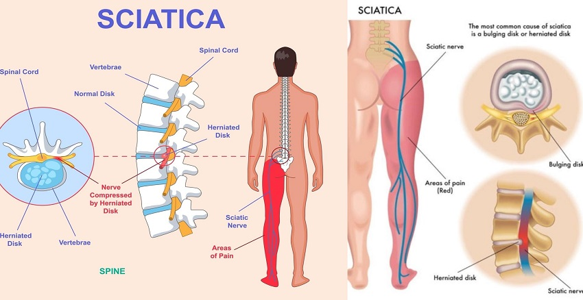 Sciatica & Nerve Pains