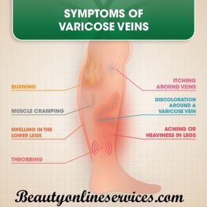 Varicose Veins Pain: Relief and Treatment Medication, Causes & Symptoms