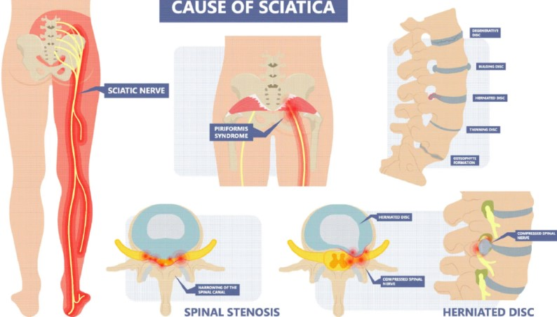 Sciatica Causes