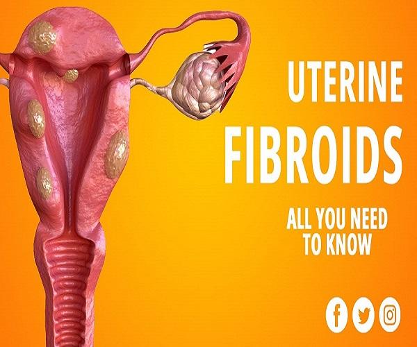 Fibroid Treatment Medicine Without Surgery: Symptoms and Causes