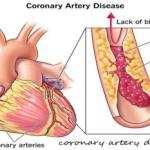 Coronary Artery Disease Treatment Medicine in Ghana