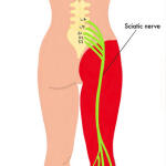 Sciatica: Causes, Symptoms, Natural Relief Strategies & Effective Treatment Supplements