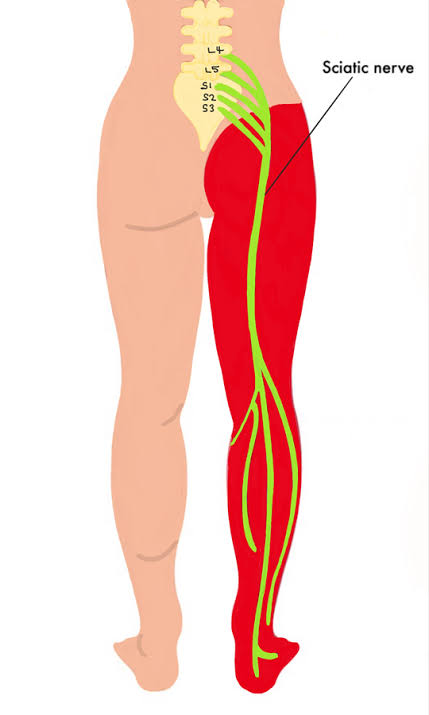 Sciatica: Causes, Symptoms, Natural Relief Strategies & Effective Treatment Supplements