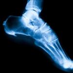 Causes of Bone Spurs in the Spine, Hip, and Knee: How They Lead to Sciatica, Preventive Strategies & Effective Treatment Supplements for Lasting Relief