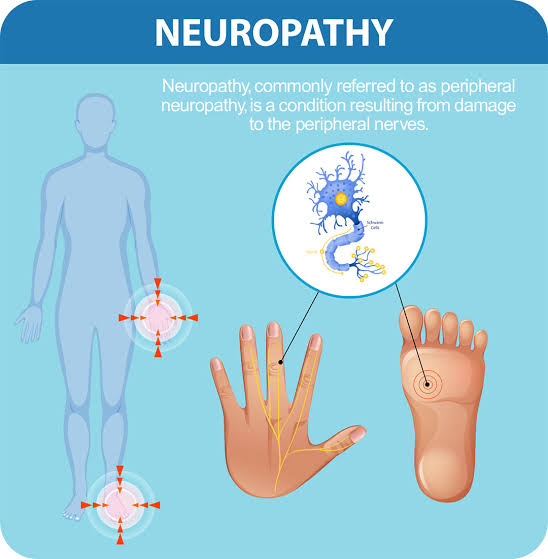Causes of Peripheral Neuropathy in Feet and Legs: Preventive Strategies & Effective Treatment Supplements