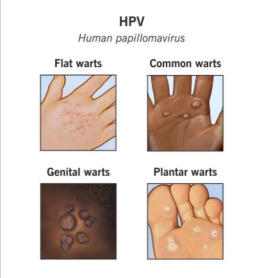 Human Papillomavirus (HPV): Symptoms, Causes, Transmission, Prevention & Medications