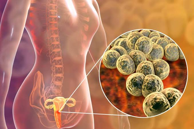 Gonorrhea: Symptoms, Causes, Transmission, Prevention & Medications