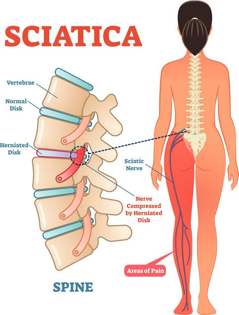 Sciatica Due to Lumbar Instability: Preventive Strategies & Effective Treatment Supplements for Lasting Relief