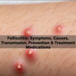 Folliculitis: Symptoms, Causes, Transmission, Prevention & Treatment Medications