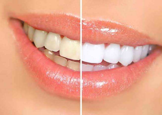 Teeth Whitening Secret Dentists Don’t Talk About: Recommended Natural Toothpaste for Stronger, Brighter Teeth & Fresh Breath