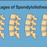 Stages of Spondylolisthesis: How They Are Linked to Sciatica, Preventive Strategies & Effective Treatment Supplement
