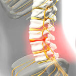 How Herniated Disk Causes Sciatica: Preventive Strategies & Effective Treatment Supplements for Lasting Relief