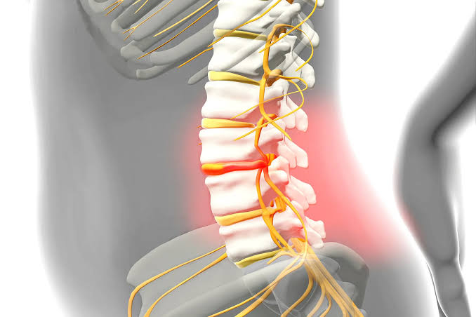 How Herniated Disk Causes Sciatica: Preventive Strategies & Effective Treatment Supplements for Lasting Relief