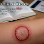 Tinea Corporis (Body Ringworm): Symptoms, Causes, Transmission, Prevention