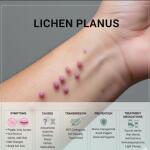 Lichen Planus: Symptoms, Causes, Transmission, Prevention & Treatment Medications