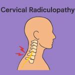Neck Nerve Compression (Cervical Radiculopathy): Causes & Effective Treatment for Lasting Relief