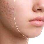 Top Natural Remedies for Acne and Scars for an Oily Skin Type
