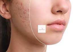 Top Natural Remedies for Acne and Scars for an Oily Skin Type
