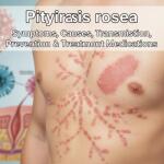 Pityriasis rosea: Symptoms, Causes, Transmission, Prevention & Treatment Medications