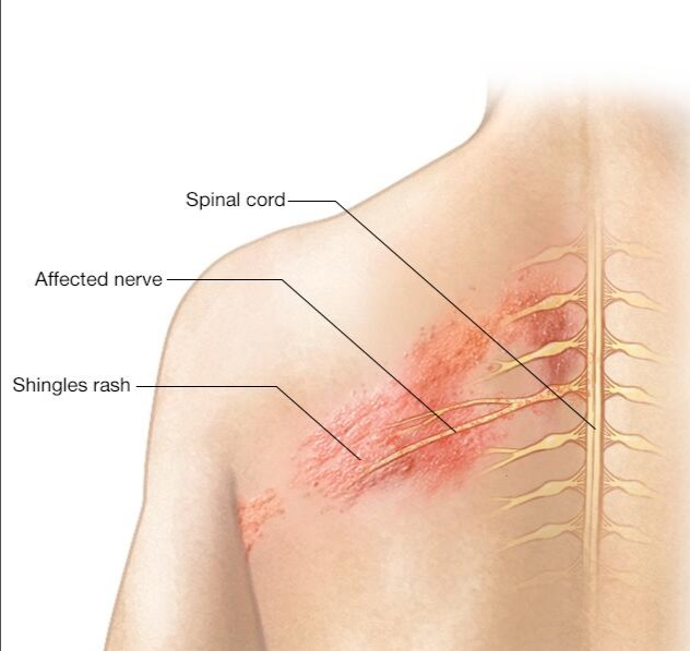 Shingles (Herpes Zoster): Symptoms, Causes, Risks, Prevention & Treatment Options
