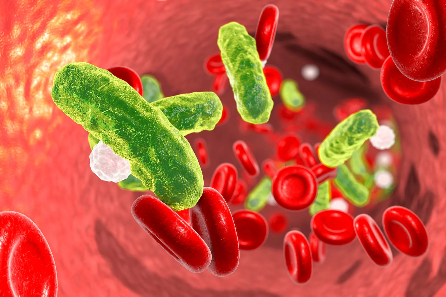 Septicemia (Blood Poisoning): Symptoms, Causes, Prevention & Medications