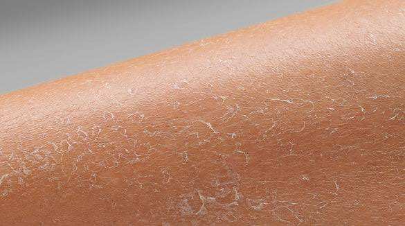 7 Proven Ways to Get Rid of Dry Skin Without Harsh Chemicals