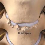 How Bone Spurs Cause Sciatica: Preventive Strategies & Effective Treatment Supplements for Lasting Relief