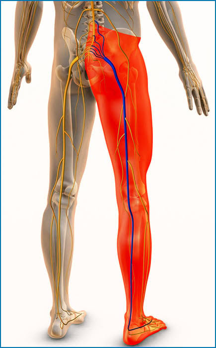 Last Stage Sciatica: Symptoms, Causes, Preventive Strategies & Effective Treatment Supplements