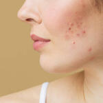 Causes of Pimples & Natural Ways to Clear the Skin Without Harsh Chemicals