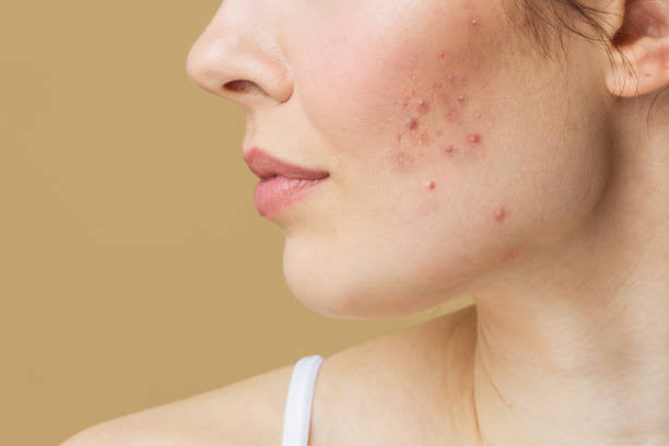 Causes of Pimples & Natural Ways to Clear the Skin Without Harsh Chemicals