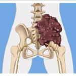 How Pelvic Tumors Cause Sciatica: Preventive Strategies & Effective Treatment Supplements